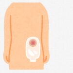 中井美穂さん、がん治療による人工肛門生活を告白