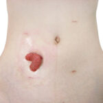 【医療事故】神奈川県立がんセンターで腸からチューブ20センチ飛び出し死亡した60代男性の名前は？