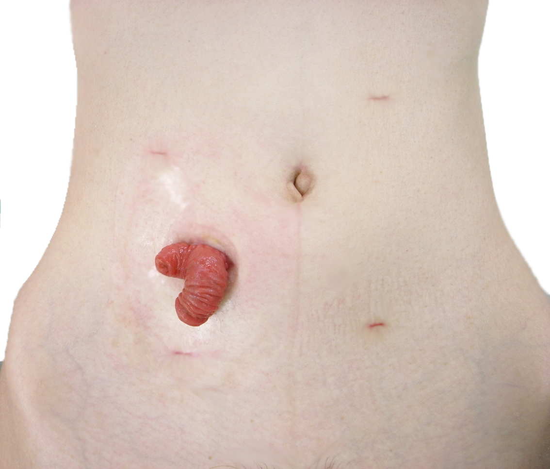 【医療事故】神奈川県立がんセンターで腸からチューブ20センチ飛び出し死亡した60代男性の名前は？